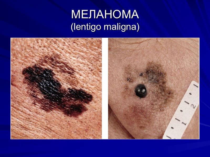 МЕЛАНОМА (lentigo maligna)